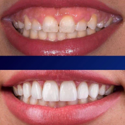 Antes y después de una Hollywood Smile