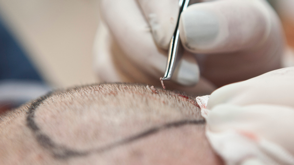 Implantación de folículos en un trasplante capilar