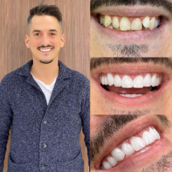 Resultado Hollywood Smile