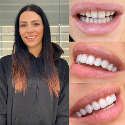 Resultado Hollywood Smile