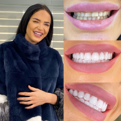 Resultado Hollywood Smile