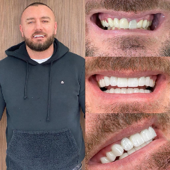 Resultado Hollywood Smile