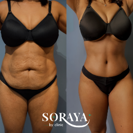 Antes y después de una abdominoplastia